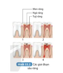 KHTN 8 Bài 32: Dinh dưỡng và tiêu hóa ở người